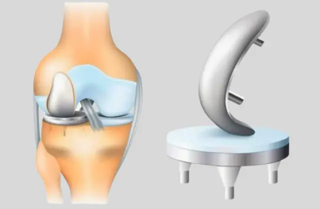 Signs You Need a Knee Replacement: When to Consider Surgery