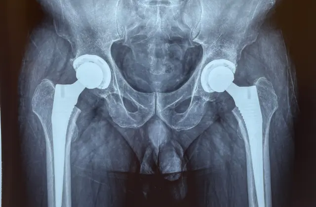 Preparing for Your Orthopedic Surgery: A Complete Guide